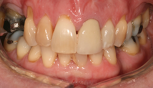 Before dental bridges at Hoddesdon Dental