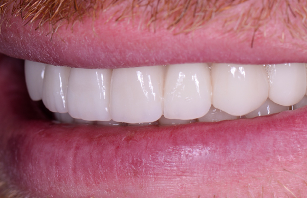 after dental implants Hertfordshire