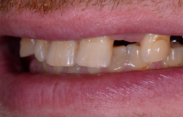 Before dental implants from a Hertford patient
