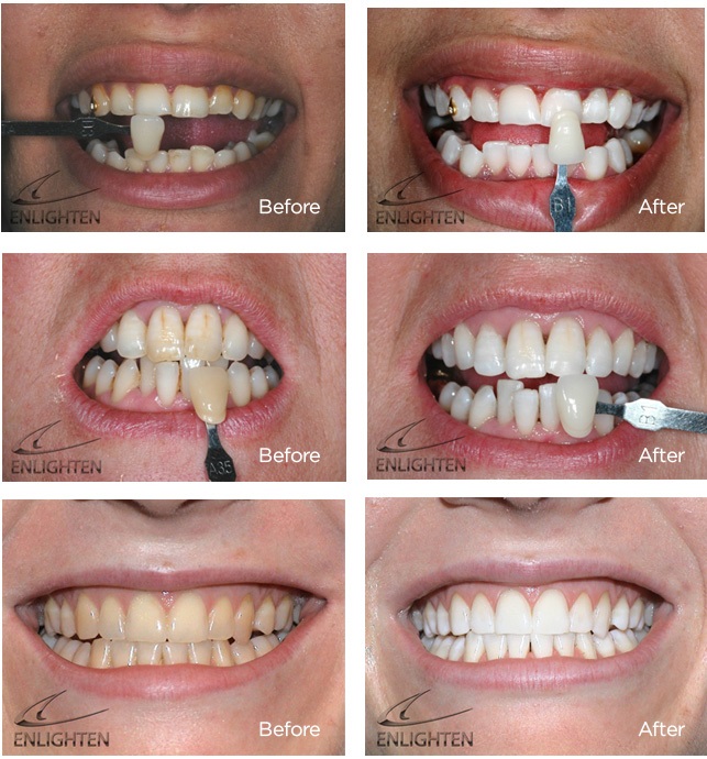 Enlighten teeth whitening near me