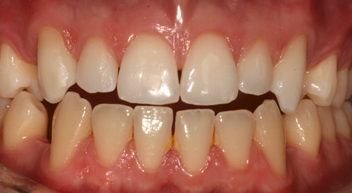 After 6 Month Smiles Treatment at Hoddesdon Dental