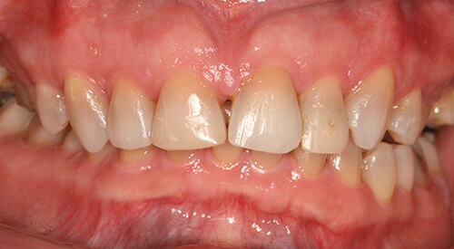 After 6 Month Smiles Treatment at Hoddesdon Dental