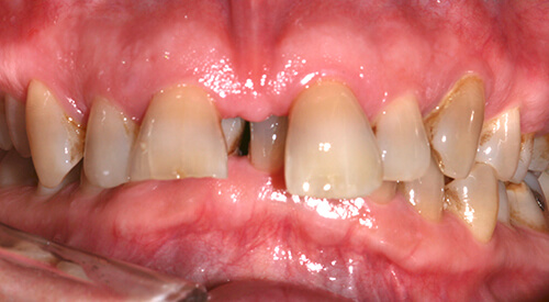 Before 6 Month Smiles Treatment at Hoddesdon Dental