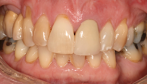 After dental bridges at Hoddesdon Dental