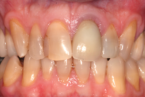 After dental crowns at Hoddesdon Dental