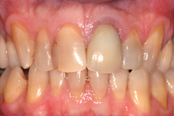 After dental crowns