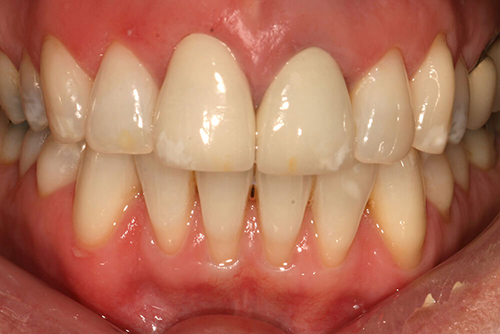 After dental crowns at Hoddesdon Dental