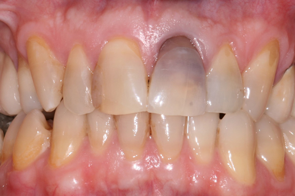 Before dental crowns at Hoddesdon Dental