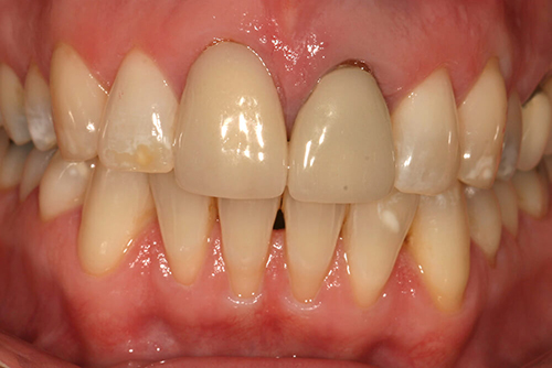 Before dental crowns at Hoddesdon Dental