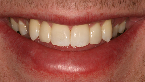 After low cost dental veneers in Hertfordshire