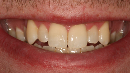 Before dental veneers at Hoddesdon Dental