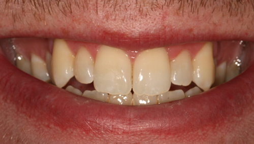 Before dental veneers Broxbourne