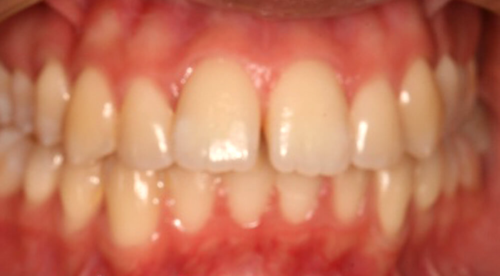 Before Invisalign treatments at Hoddesdon Dental