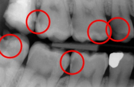 Example of Digital X-Ray at Hoddesdon Dental