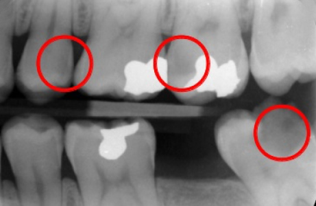 Example of Digital X-Ray at Hoddesdon Dental